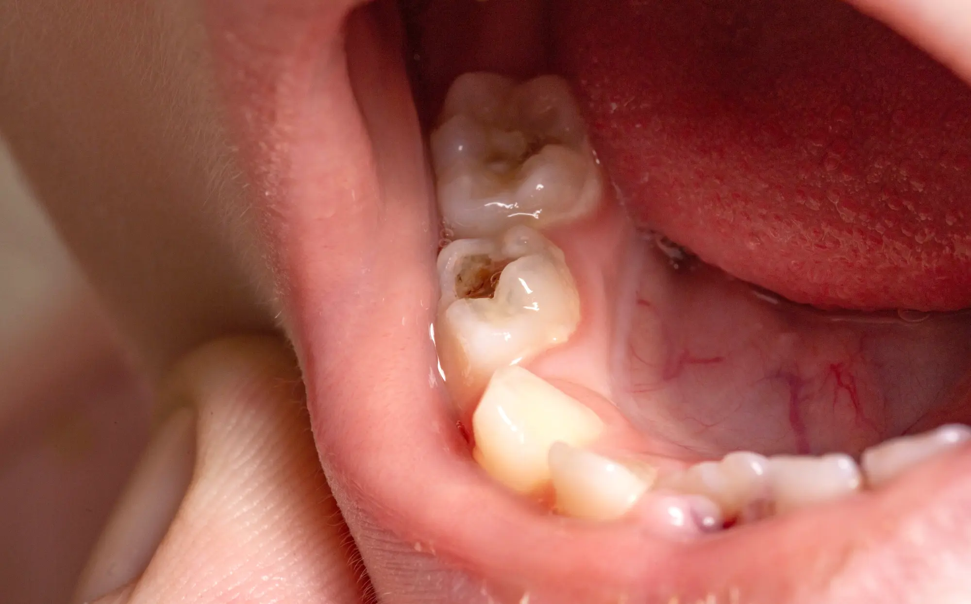 Why Do Some Children Get Frequent Cavities Despite Regular Brushing?