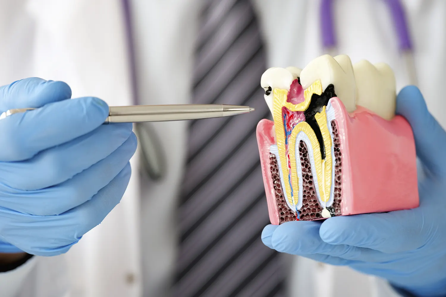 How Dentists Find Hidden Cavities Between Teeth Before They Cause Pain