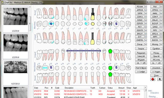 Dental chart showing teeth diagram with color-coded treatment status, bitewing and panoramic X-rays on the left, and a list of procedure codes and descriptions below.