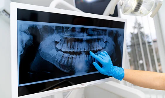 Dentist wearing a blue glove pointing to a dental X-ray of a full set of teeth on a computer screen.