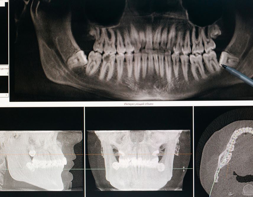 kid’s dentist for preventing tooth extraction 