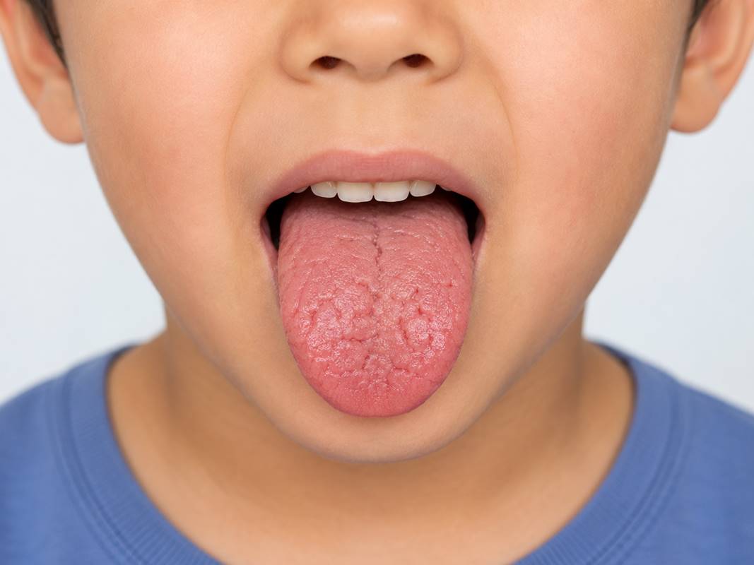 Fissured Tongue in Kids: Causes, Symptoms & Treatment