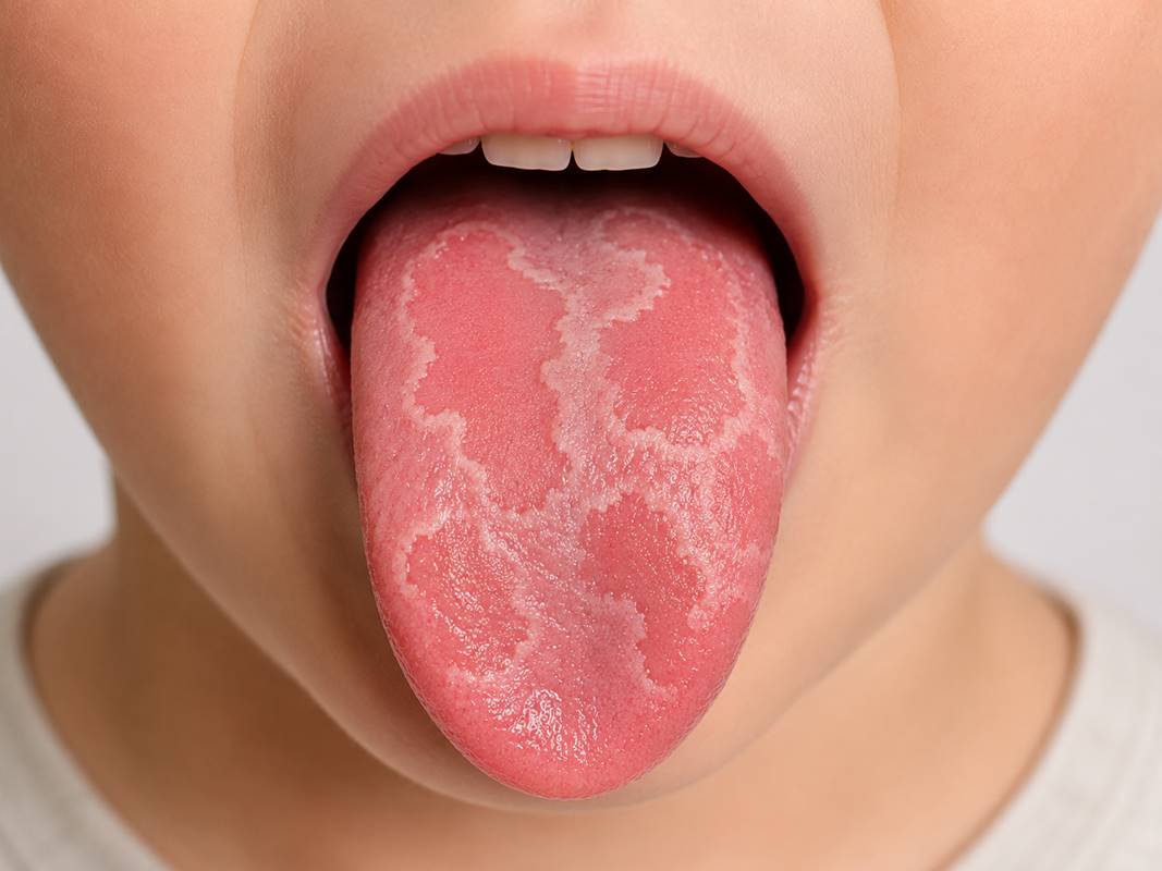 Geographic Tongue in Children: Causes & Treatment | Las Vegas
