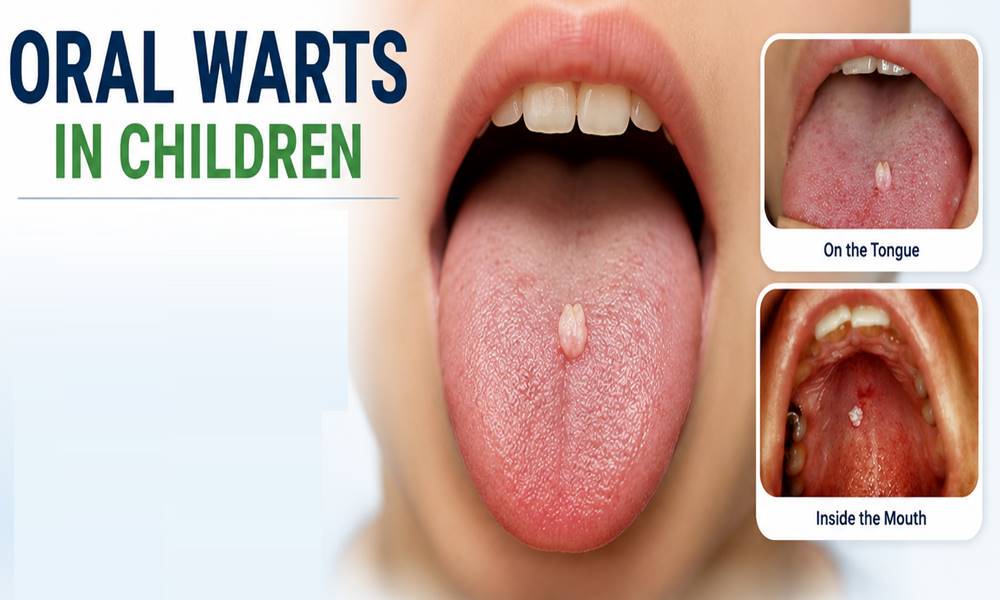 Oral Warts in Children: Causes, Symptoms & Treatment