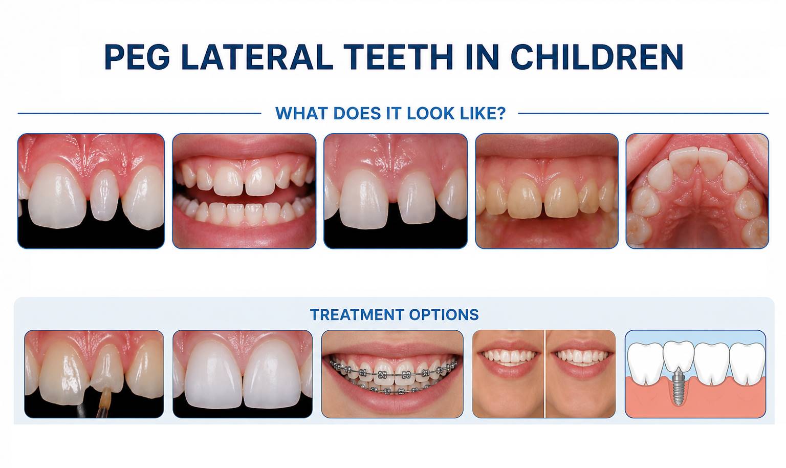 Peg Lateral Teeth in Children: Causes, Symptoms & Treatment