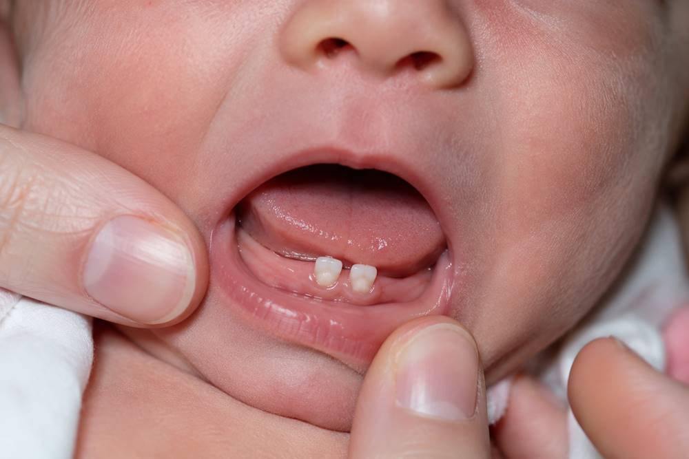 Natal Teeth in Newborns
