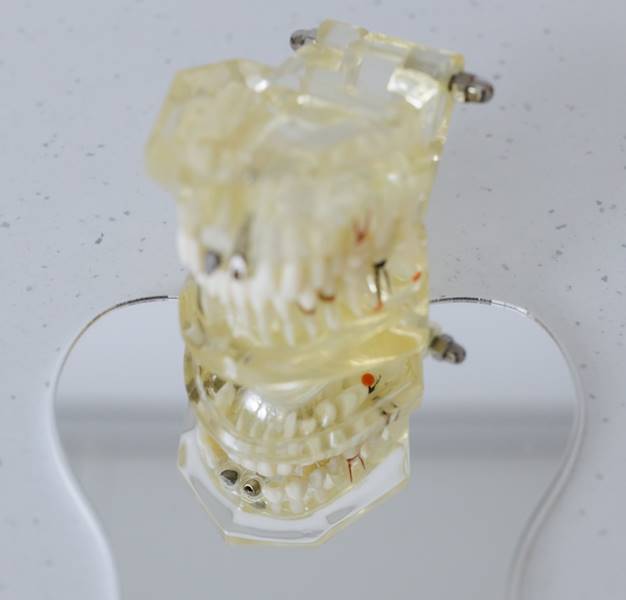 Turner’s tooth 