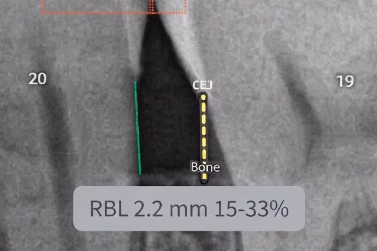 Denti.AI Detect highlighting findings on a set of radiographs.