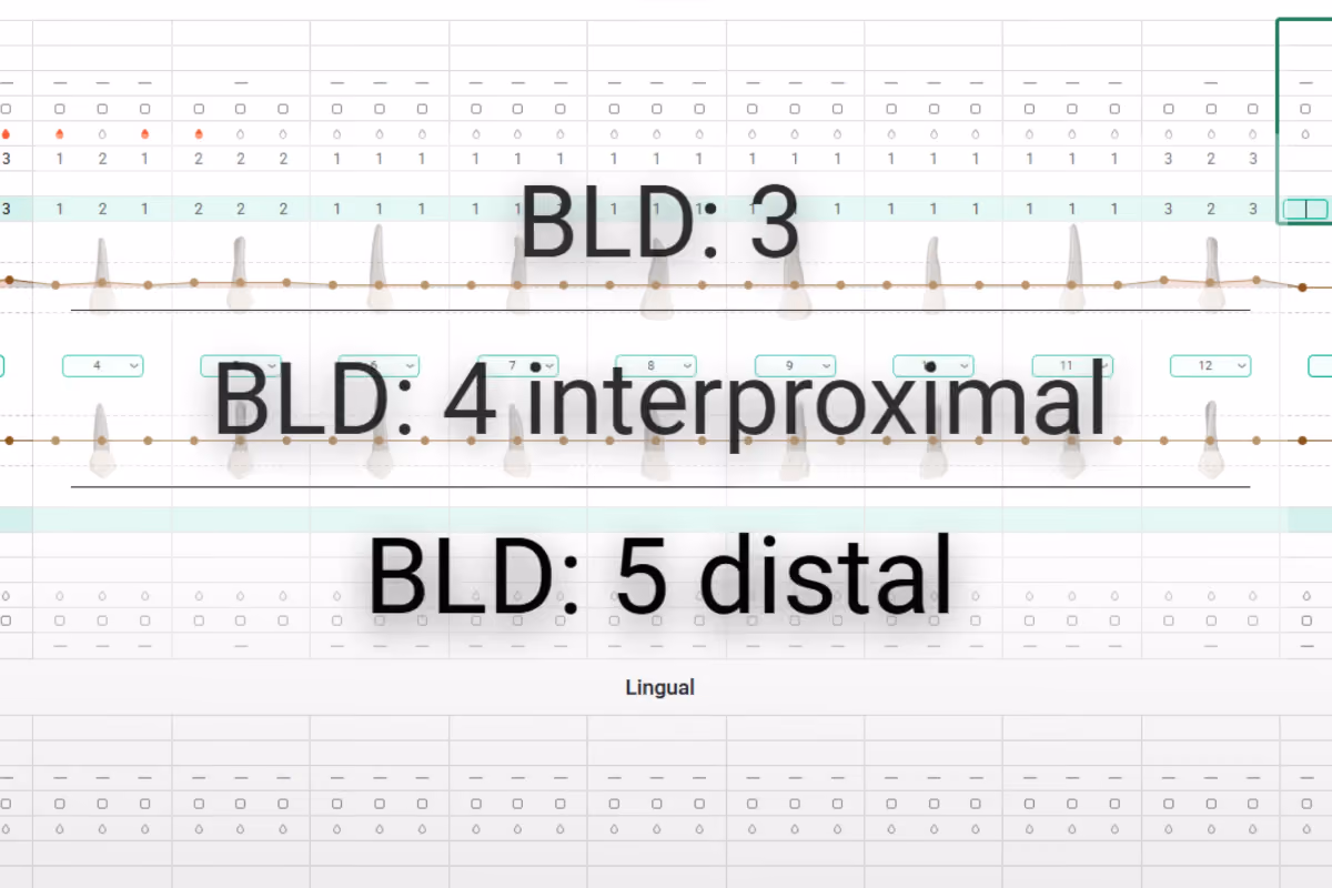 Denti.AI Voice Perio charting a periodontal exam hands-free by voice.
