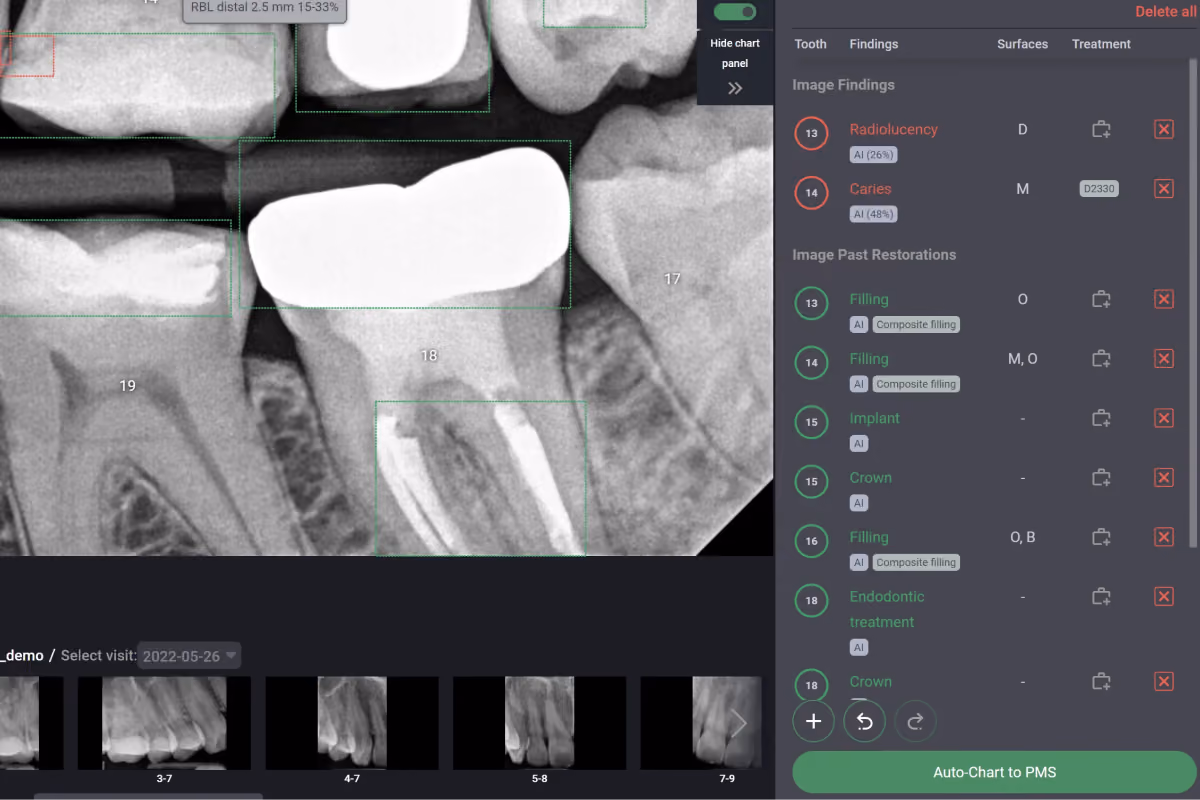 Denti.AI Auto-Chart pushing confirmed conditions and codes into the PMS.