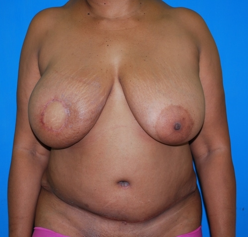 After surgery image