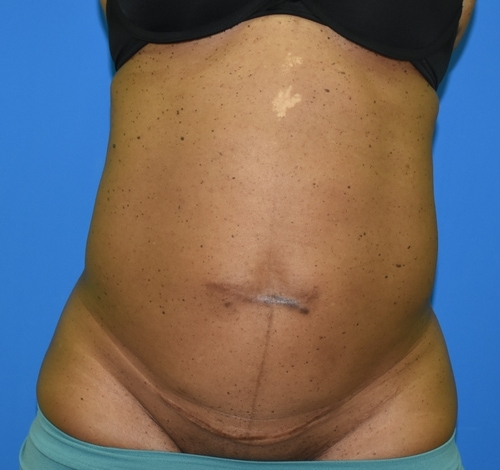 Before surgery image