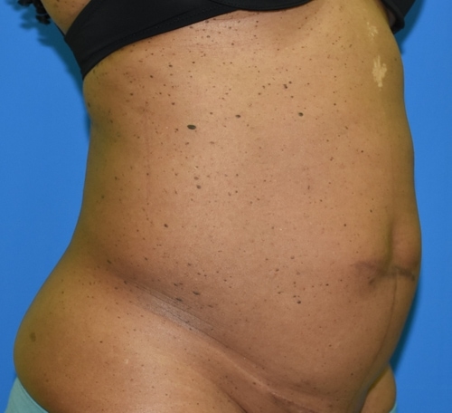 Before surgery image