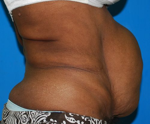 Before surgery image