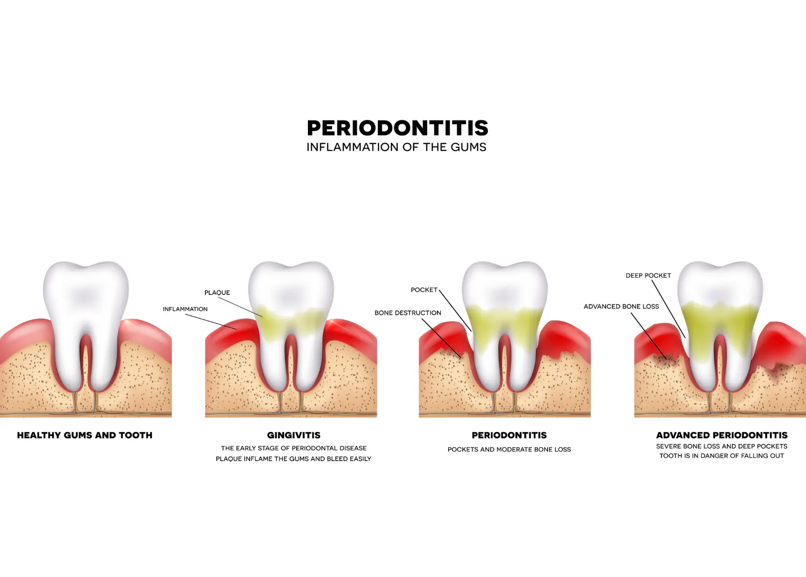 Illustration of various stages of gum disease.