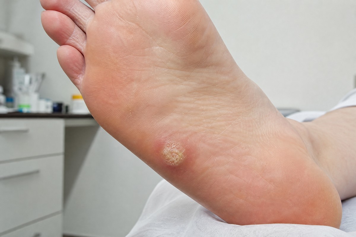 Plantar Warts in Walnut Creek: Causes, Symptoms, and Effective Treatments