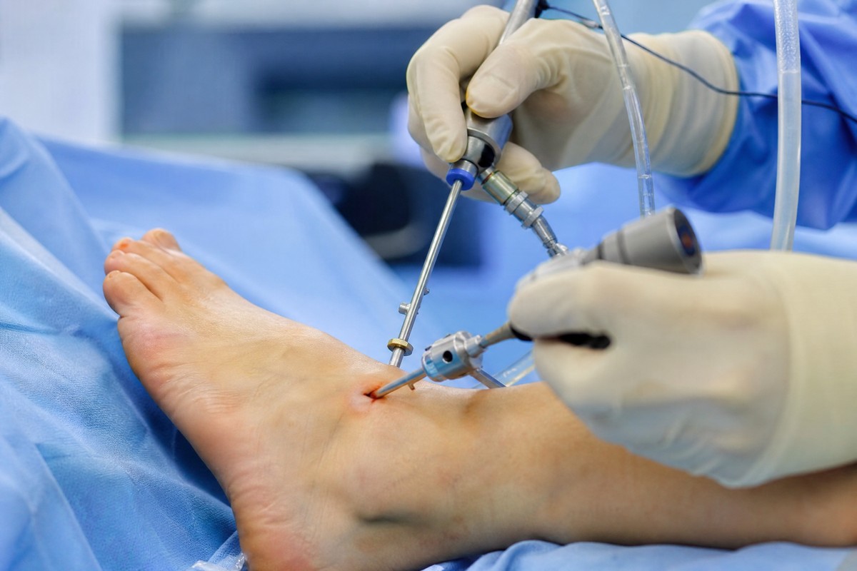 Minimally Invasive Bunion Surgery in Walnut Creek: The Modern Alternative to Traditional Surgery