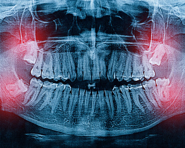 Can Wisdom Teeth Grow Back After They've Been Removed?