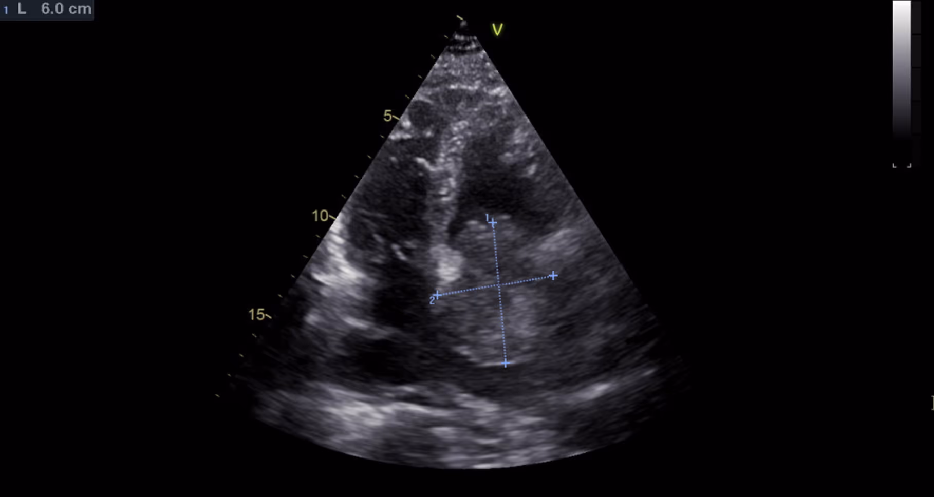 Giant myxoma in left atrium