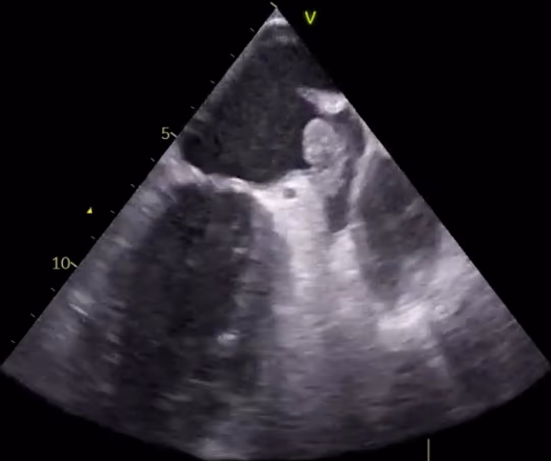 Massive left atrial appendage thrombosis