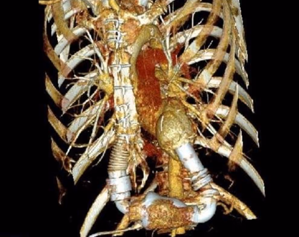 A Complex Heart Team's Approach to a Patient With Giant Cell Myocarditis