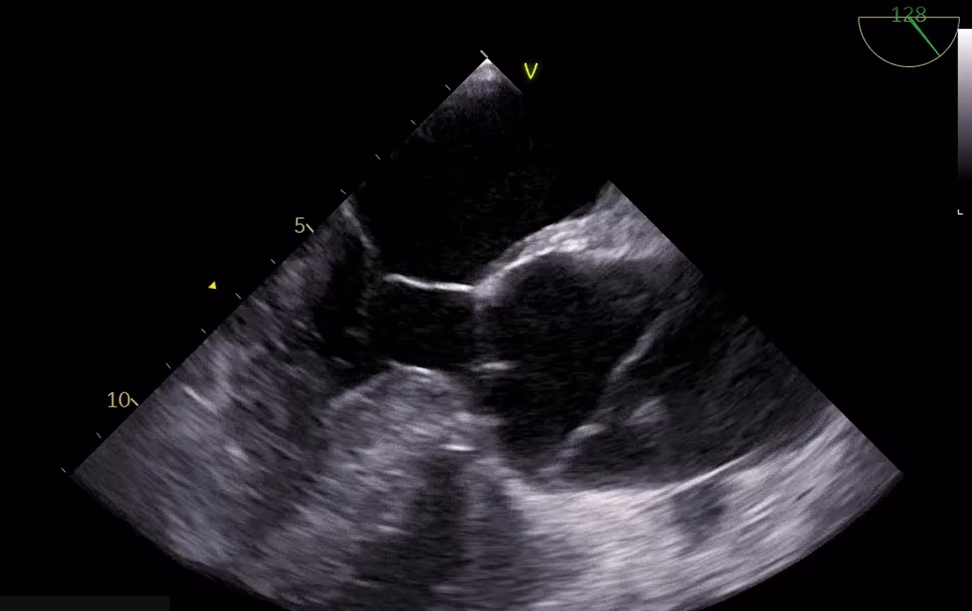 Patient with a Stanford type A aortic dissection 