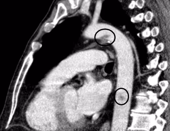 Thrombotic complications in a patient with COVID-19 pneumonia