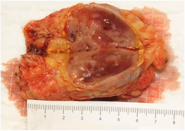 Feochromocytoma as an unusual cause for refractory ventricular fibrillation
