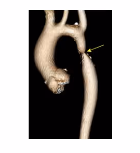 Patient with Coarctation of Aorta