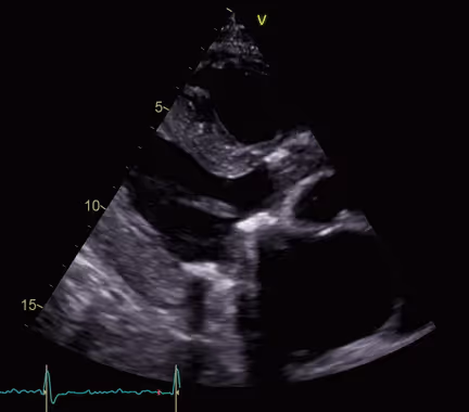 Junctional rhythm as a complication of Fabry Disease