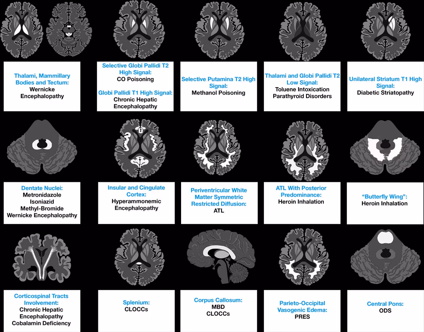 Imaging Patterns of Toxic and Metabolic Brain Disorders