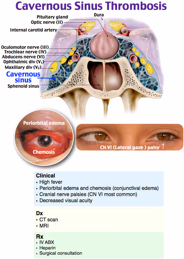 Cavernous sinus thrombosis