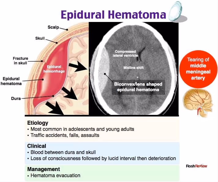 Epidural heamatoma