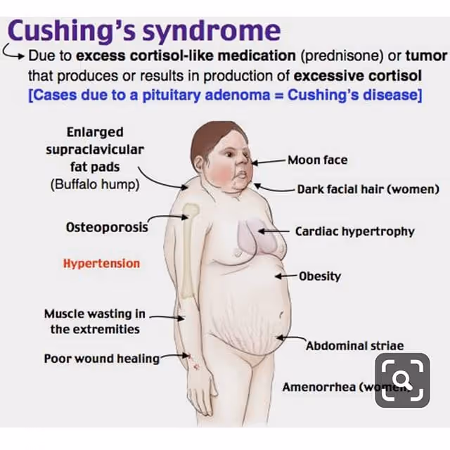 Cushing syndrome