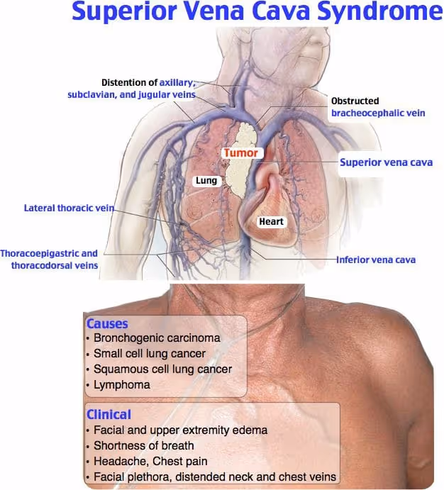 Superior vena cava syndrome