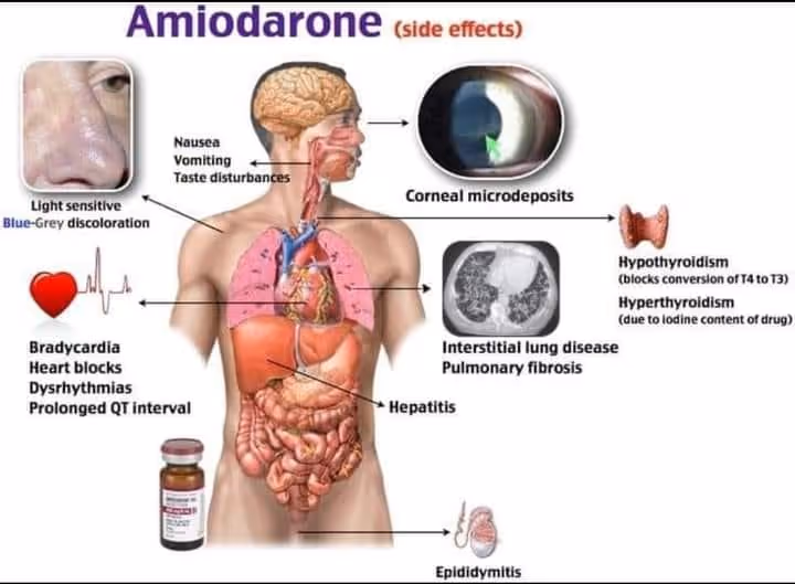 Amiodarone side effects