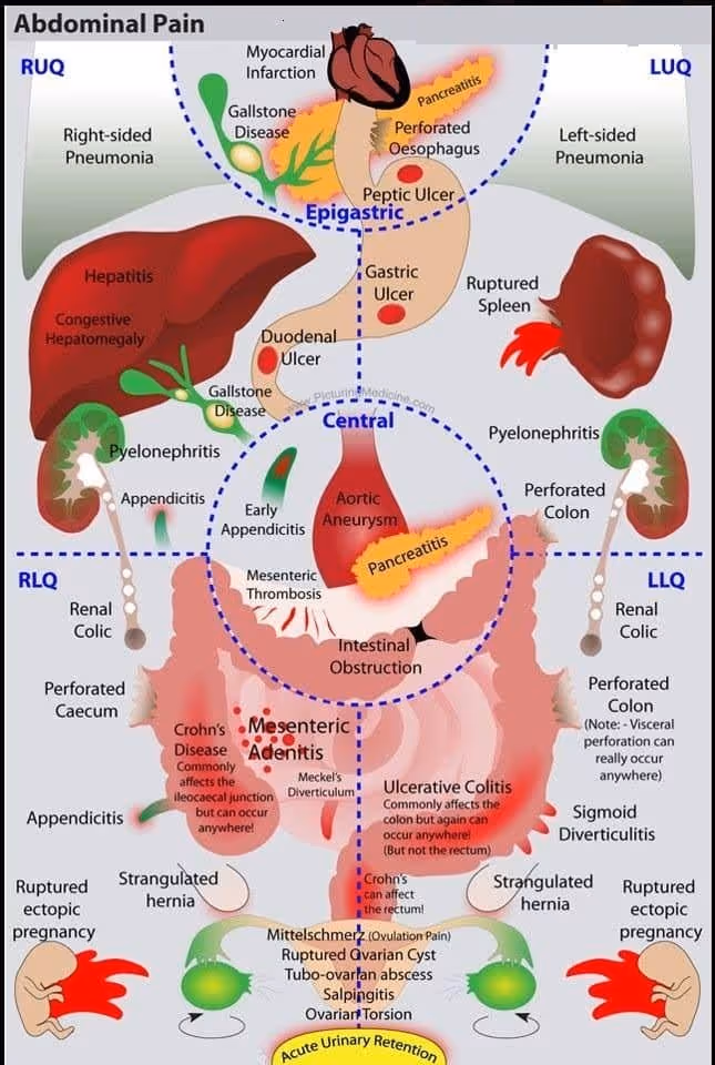 Abdominal pain