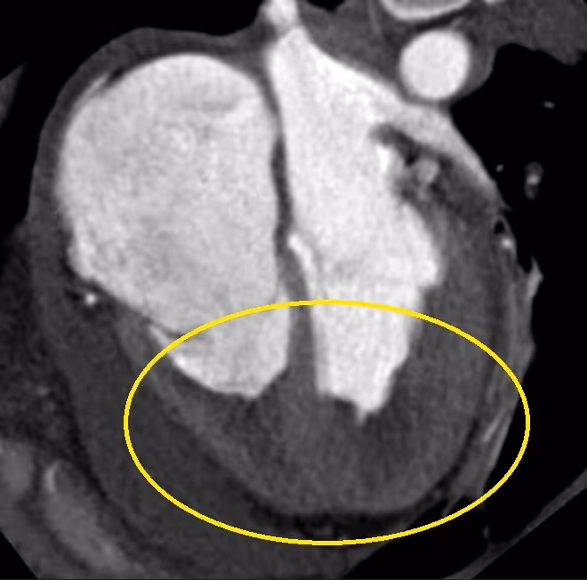 Endomyocardial fibrosis in a young patient