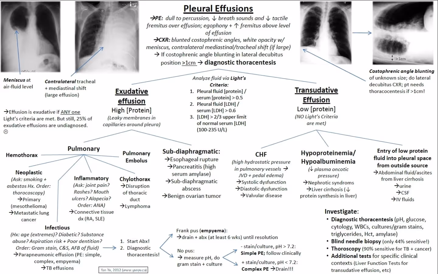 Pleural effusion