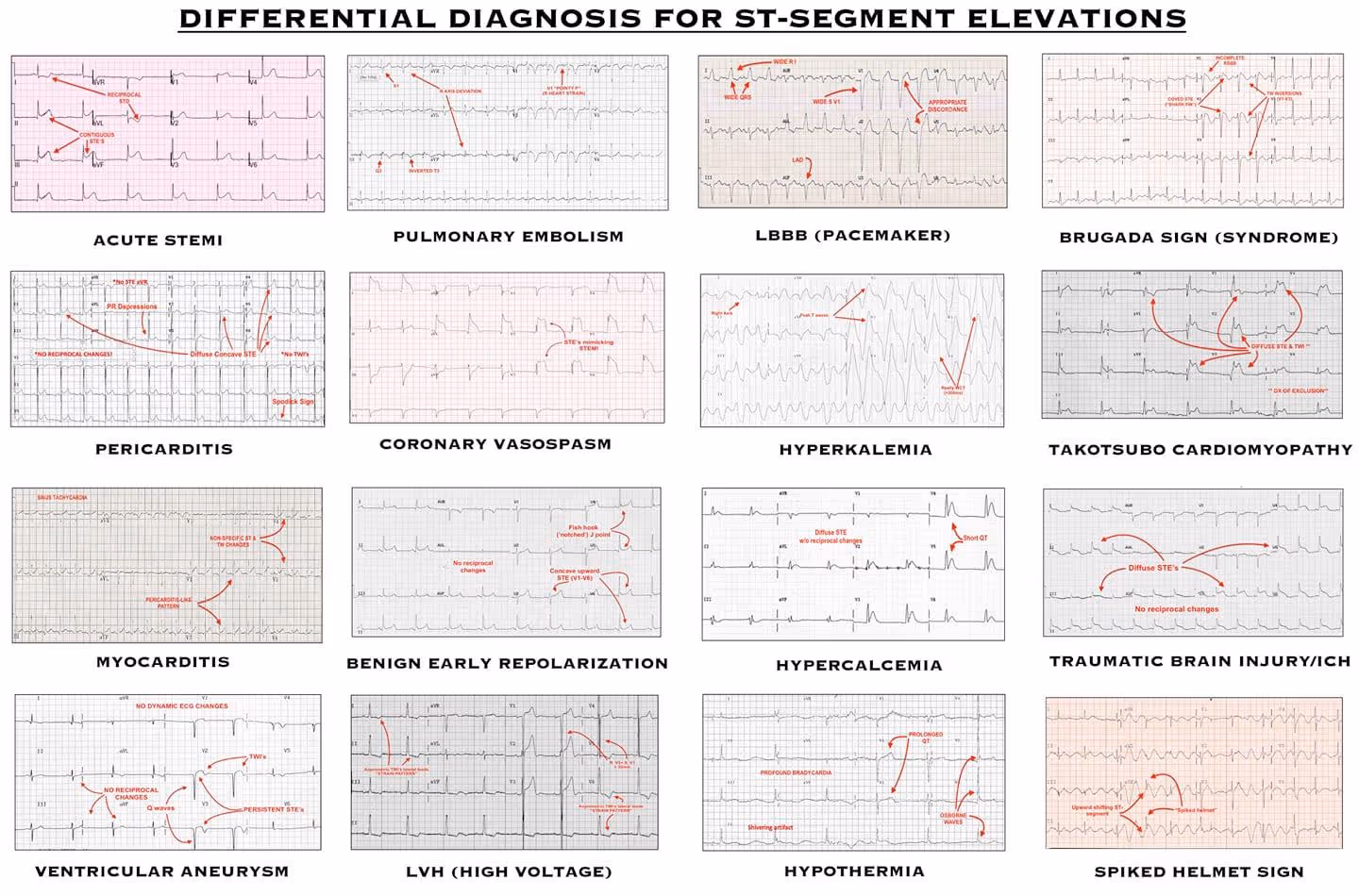 ST segment elevations