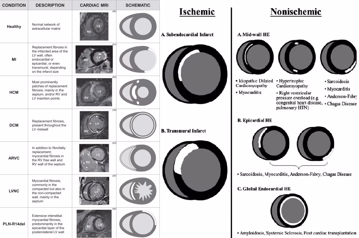 LGE distribution on CMR