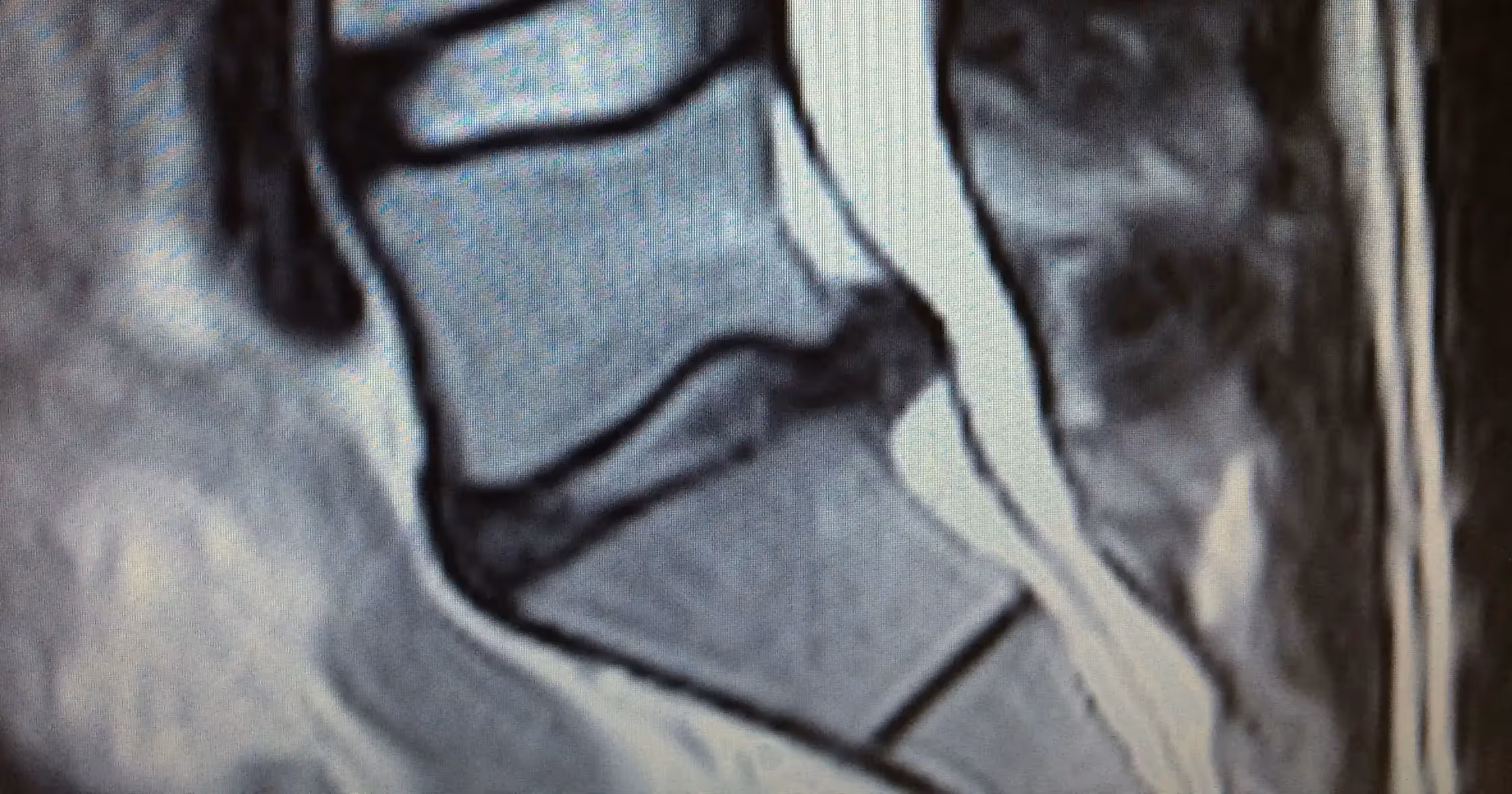 MRI for low back pain: Is it necessary?