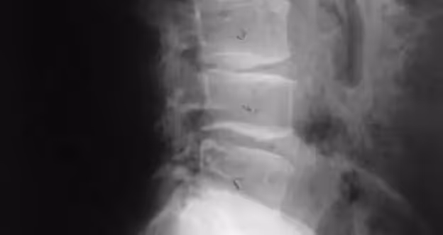 What I Tell My Patients To Avoid With Degenerative Disc Disease? 