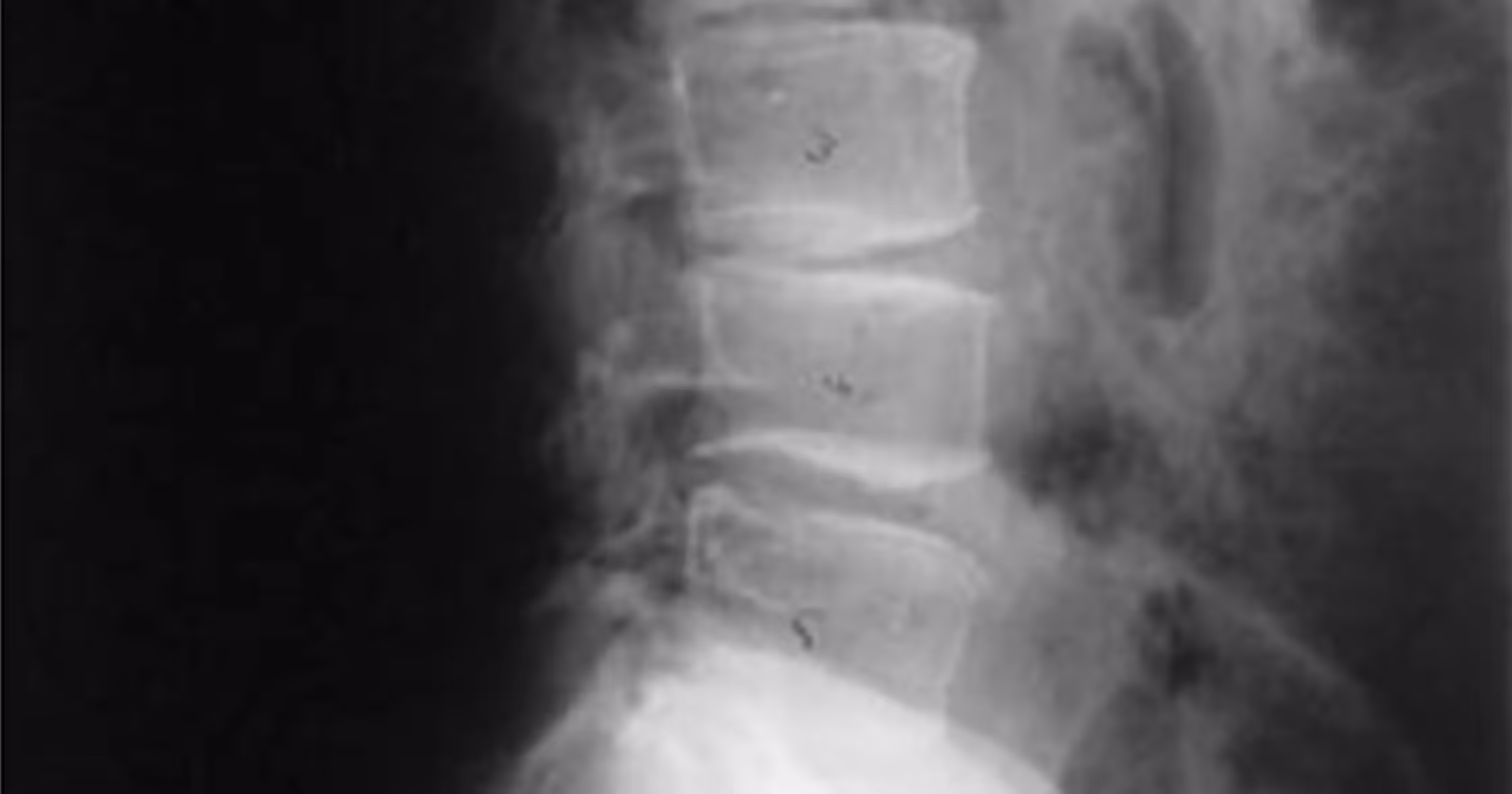 What I Tell My Patients To Avoid With Degenerative Disc Disease? 