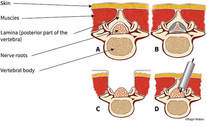 Lumbar Laminectomy For Spinal Stenosis