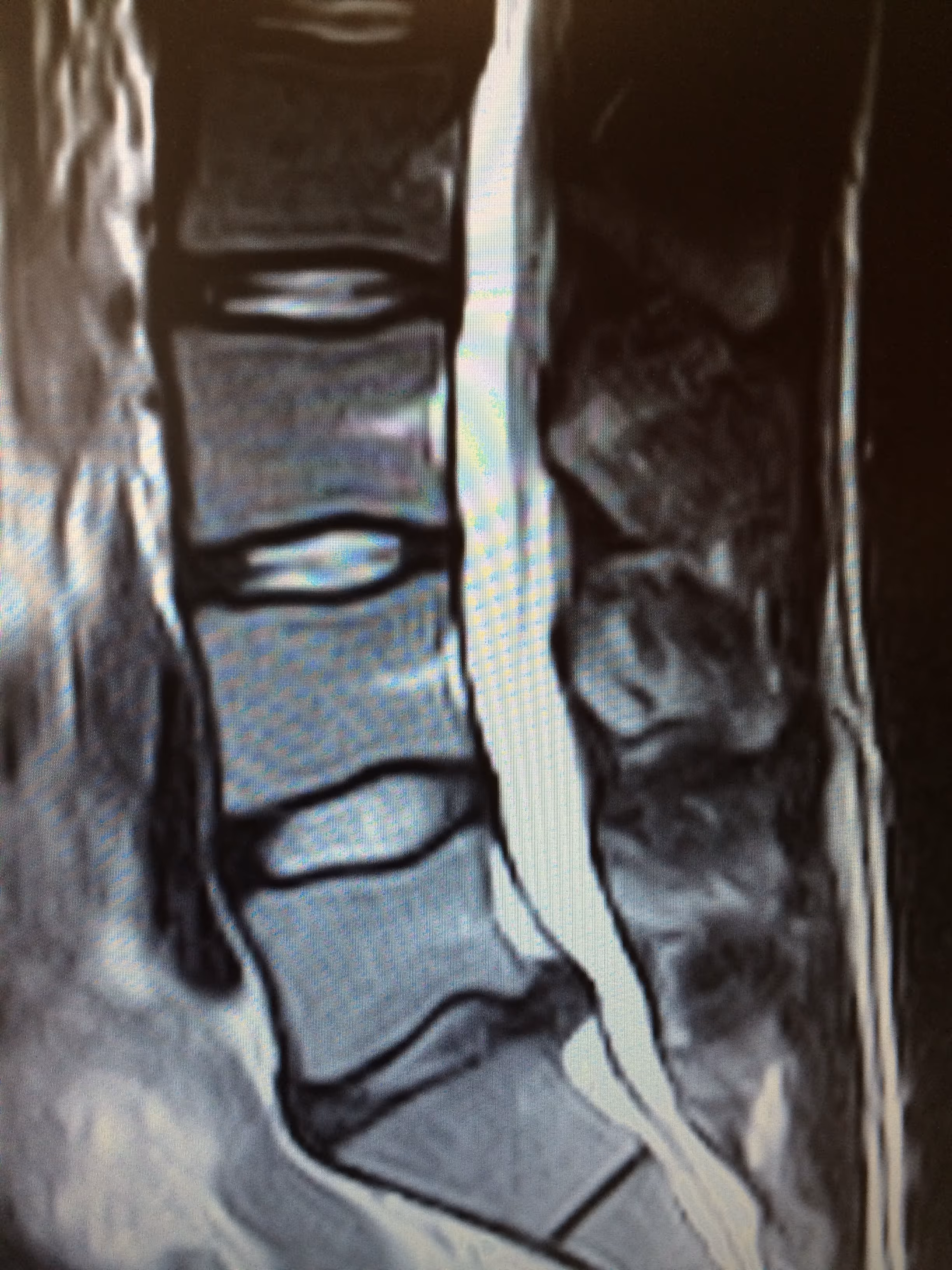 MRI lumbar spine disc herniation L5-S1 with leg pain