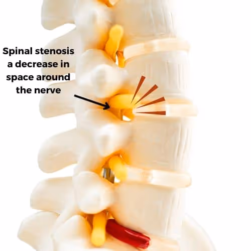 Spine showing spinal stenosis