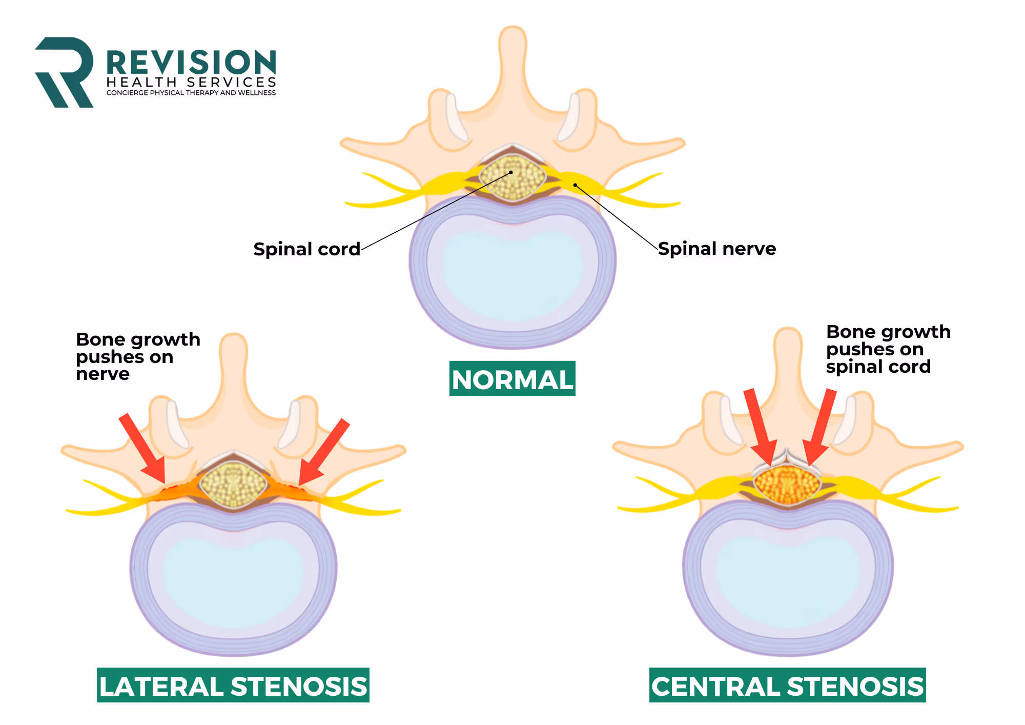 Stenosis Information 