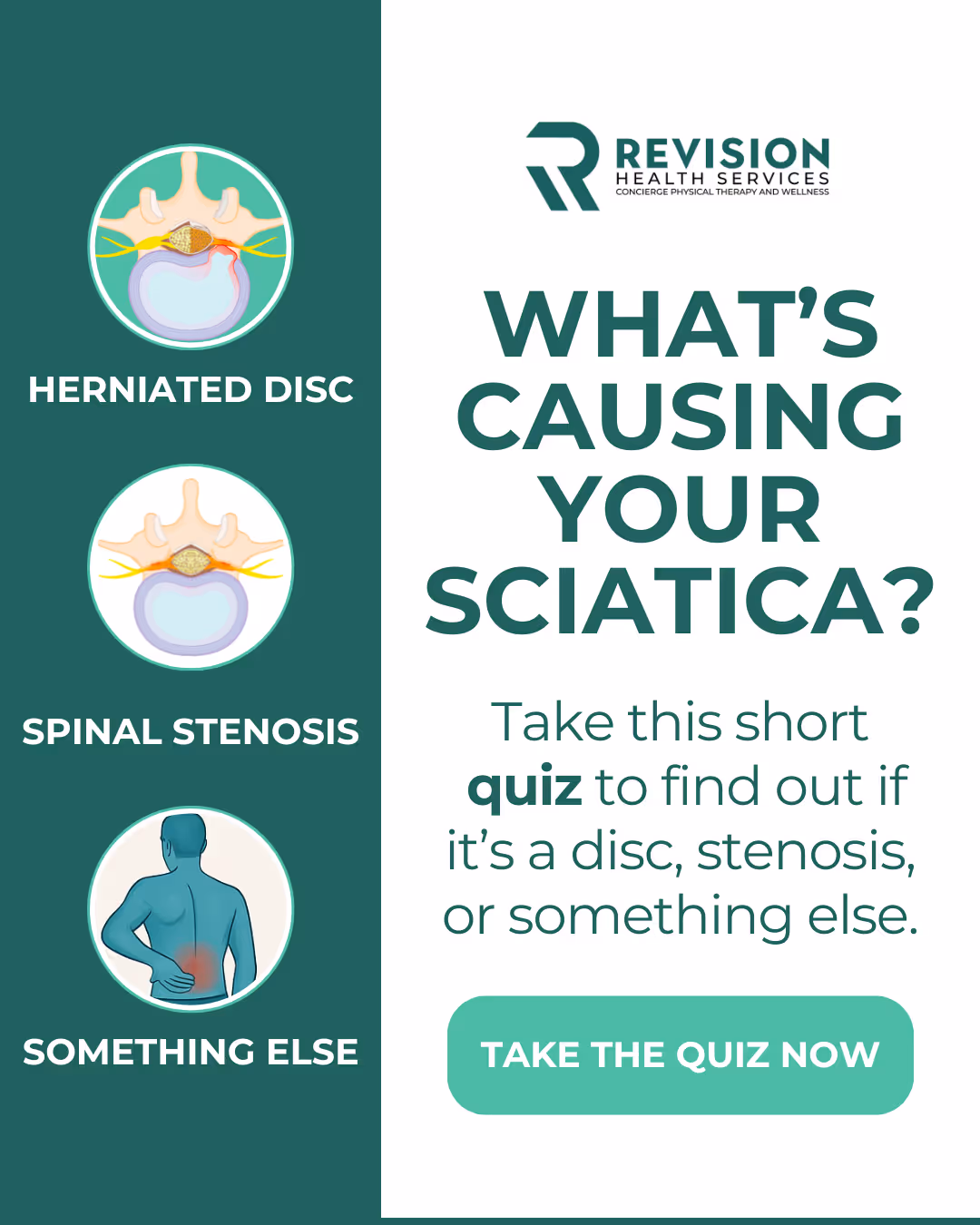 What is Causing Your Sciatica Pain, Free Sciatica Assessment