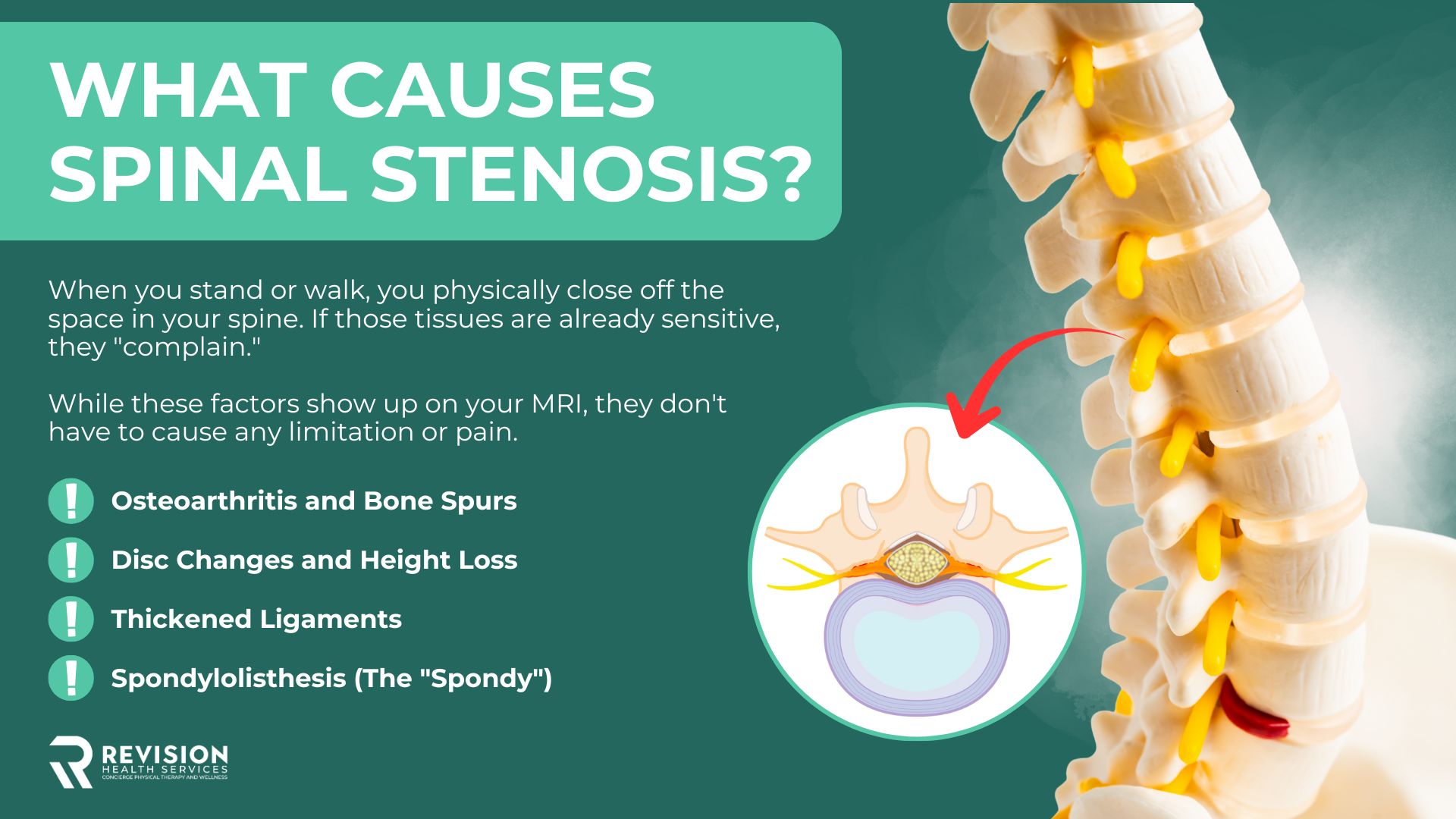 Infographic showing what causes spinal stenosis?